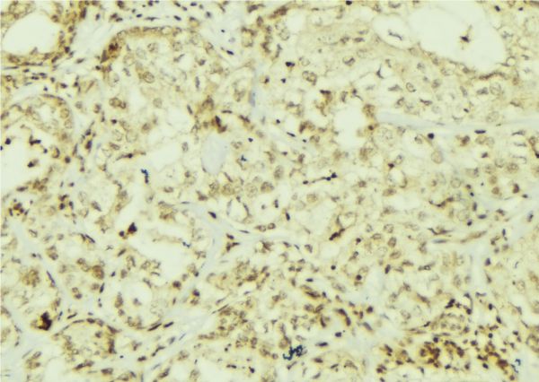 AKT1 Antibody - 1:100 staining human breast carcinoma tissue by IHC-P. The sample was formaldehyde fixed and a heat mediated antigen retrieval step in citrate buffer was performed. The sample was then blocked and incubated with the antibody for 1.5 hours at 22°C. An HRP conjugated goat anti-rabbit antibody was used as the secondary.