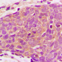 AKT1S1 / PRAS40 Antibody - Immunohistochemical analysis of PRAS40 staining in human breast cancer formalin fixed paraffin embedded tissue section. The section was pre-treated using heat mediated antigen retrieval with sodium citrate buffer (pH 6.0). The section was then incubated with the antibody at room temperature and detected using an HRP-conjugated compact polymer system. DAB was used as the chromogen. The section was then counterstained with hematoxylin and mounted with DPX.
