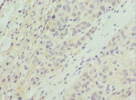 AKT1S1 / PRAS40 Antibody - Immunohistochemistry of paraffin-embedded human liver cancer at dilution 1:100