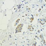 AKT1S1 / PRAS40 Antibody - Immunohistochemistry of paraffin-embedded Human mammary cancer using AKT1S1 Polyclonal Antibody at dilution of 1:200 (40x lens).
