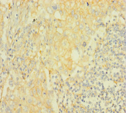 AKT2 Antibody - Immunohistochemistry of paraffin-embedded human lung cancer using AKT2 Antibody at dilution of 1:100