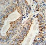AKT2 Antibody - AKT2 Monoclonal Antibody immunohistochemistry of formalin-fixed and paraffin-embedded human prostate carcinoma followed by peroxidase-conjugated secondary antibody and DAB staining.