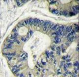 AKT2 Antibody - Formalin-fixed and paraffin-embedded human colon carcinoma reacted with AKT2 Antibody , which was peroxidase-conjugated to the secondary antibody, followed by DAB staining. This data demonstrates the use of this antibody for immunohistochemistry; clinical relevance has not been evaluated.