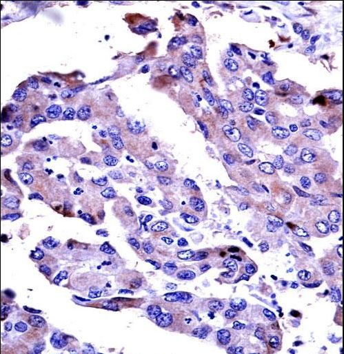 AKT2 Antibody - AKT2 Antibody immunohistochemistry of formalin-fixed and paraffin-embedded human lung adenocarcinoma followed by peroxidase-conjugated secondary antibody and DAB staining.