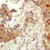 AKT2 Antibody - Immunohistochemical analysis of AKT2 (pS474) staining in human breast cancer formalin fixed paraffin embedded tissue section. The section was pre-treated using heat mediated antigen retrieval with sodium citrate buffer (pH 6.0). The section was then incubated with the antibody at room temperature and detected using an HRP polymer system. DAB was used as the chromogen. The section was then counterstained with hematoxylin and mounted with DPX.