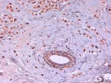 AKT2 Antibody - Immunohistochemistry of Rat monoclonal anti AKT2 unconjugated Antibody in human breast carcinoma. Tissue: Human Breast Cancer. Fixation: FFPE buffered formalin 10% conc. Ag Retrieval: Heat, Citrate pH 6.2. Pressure Cooker. antibody: anti-AKT2 at 2ug/ml for 1.5 hour @ room temp. Secondary Ab: mouse anti-rat at 1:50 for 45” RT.