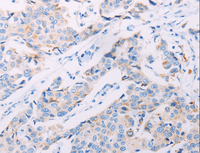 AKT2 Antibody - Immunohistochemistry of paraffin-embedded Human breast cancer using AKT2 Polyclonal Antibody at dilution of 1:70.