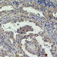 AKT2 Antibody - Immunohistochemical analysis of AKT2 staining in human lung cancer formalin fixed paraffin embedded tissue section. The section was pre-treated using heat mediated antigen retrieval with sodium citrate buffer (pH 6.0). The section was then incubated with the antibody at room temperature and detected using an HRP conjugated compact polymer system. DAB was used as the chromogen. The section was then counterstained with hematoxylin and mounted with DPX.