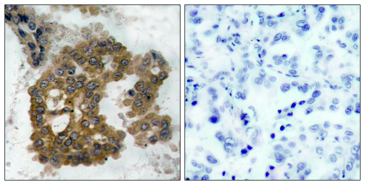 AKT2 Antibody - Immunohistochemistry analysis of paraffin-embedded human lung carcinoma, using Akt2 (Phospho-Ser474) Antibody. The picture on the right is blocked with the phospho peptide.