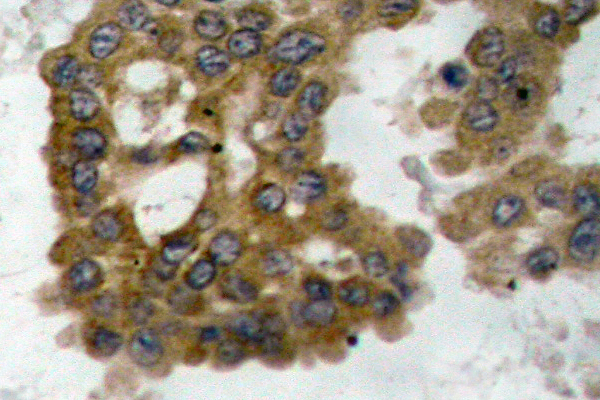 AKT2 Antibody - IHC of p-Akt2 (S474) pAb in paraffin-embedded human lung carcinoma tissue.