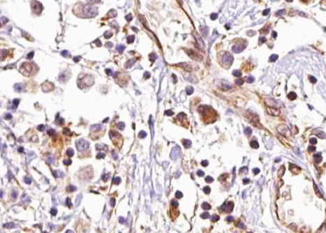 AKT2 Antibody - 1:100 staining human breast carcinoma tissue by IHC-P. The tissue was formaldehyde fixed and a heat mediated antigen retrieval step in citrate buffer was performed. The tissue was then blocked and incubated with the antibody for 1.5 hours at 22°C. An HRP conjugated goat anti-rabbit antibody was used as the secondary.