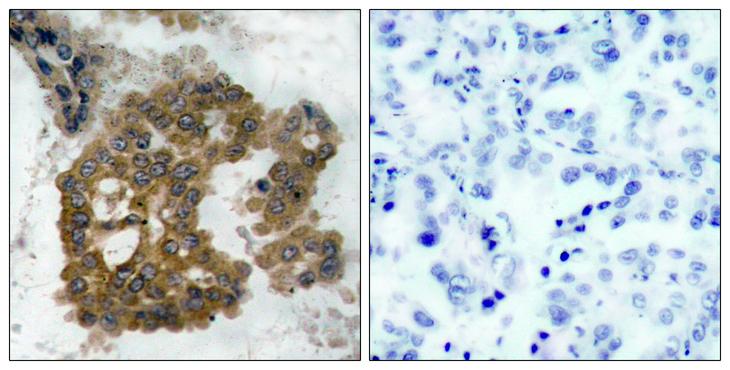 AKT2 Antibody - P-Peptide - + Immunohistochemical analysis of paraffin-embedded human lung carcinoma tissue using Akt2 (phospho- Ser474) antibody.