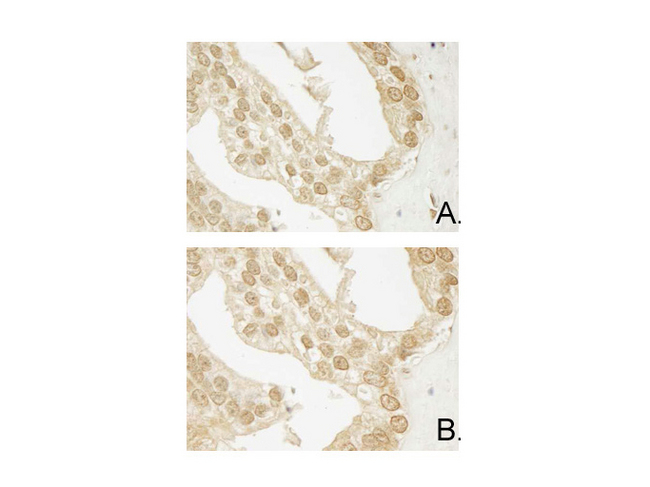 AKT3 Antibody - Immunohistochemistry of Mouse Anti-AKT3 antibody. Tissue: human prostate carcinoma. A) AKT-3 antibody produced using CELLine, B) AKT-3 antibody produced using roller bottle. Fixation: formalin fixed paraffin embedded. Antigen retrieval: not required. Primary antibody: AKT-3 unconjugated antibody at 10 µg/mL for 1 h at RT. Secondary antibody: Peroxidase mouse secondary antibody at 1:10,000 for 1 h at RT. Localization: AKT3 is nuclear and occasionally cytoplasmic. Staining: AKT3 as precipitated brown signal with hematoxylin purple nuclear counterstain.