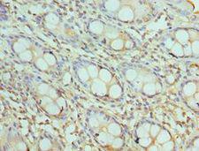AKTIP / FTS Antibody - Immunohistochemistry of paraffin-embedded human rectal cancer using antibody at 1:100 dilution.