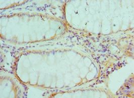 AKTIP / FTS Antibody - Immunohistochemistry of paraffin-embedded human colon cancer using antibody at 1:100 dilution.