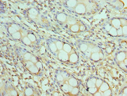 AKTIP / FTS Antibody - Immunohistochemistry of paraffin-embedded human colon cancer using AKTIP Antibody at dilution of 1:100