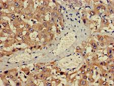 ALAS1 Antibody - Immunohistochemistry image of paraffin-embedded human liver cancer at a dilution of 1:100