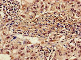 ALAS1 Antibody - Immunohistochemistry image of paraffin-embedded human lung cancer at a dilution of 1:100