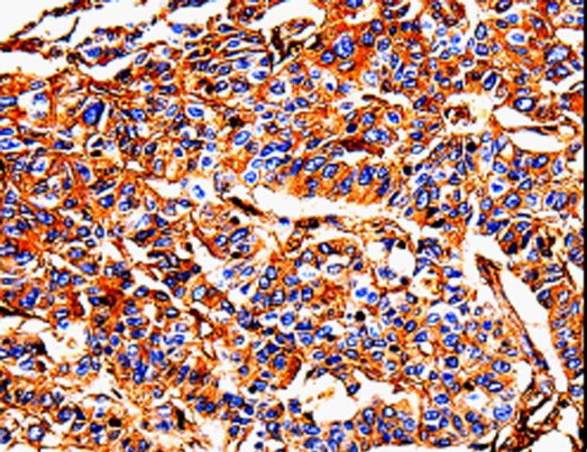 ALB / Serum Albumin Antibody - Immunohistochemistry of paraffin-embedded Human liver cancer using ALB Polyclonal Antibody at dilution of 1:25.