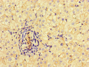 ALB / Serum Albumin Antibody - Immunohistochemistry of paraffin-embedded human liver cancer at dilution of 1:100
