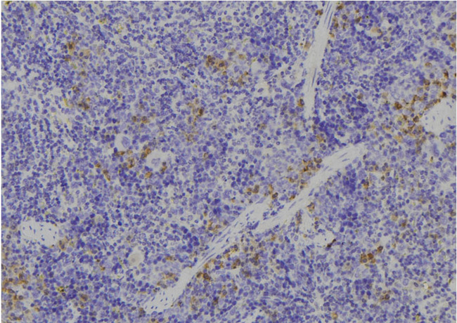 ALB / Serum Albumin Antibody - 1:100 staining human spleen tissue by IHC-P. The sample was formaldehyde fixed and a heat mediated antigen retrieval step in citrate buffer was performed. The sample was then blocked and incubated with the antibody for 1.5 hours at 22°C. An HRP conjugated goat anti-rabbit antibody was used as the secondary.