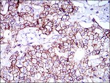 ALCAM / CD166 Antibody - IHC of paraffin-embedded prostate cancer tissues using ALCAM mouse monoclonal antibody with DAB staining.