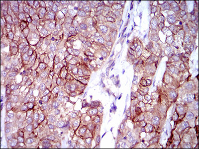 ALCAM / CD166 Antibody - IHC of paraffin-embedded bladder cancer tissues using ALCAM mouse monoclonal antibody with DAB staining.