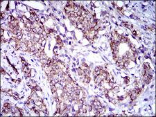 ALCAM / CD166 Antibody - IHC of paraffin-embedded cervical cancer tissues using ALCAM mouse monoclonal antibody with DAB staining.
