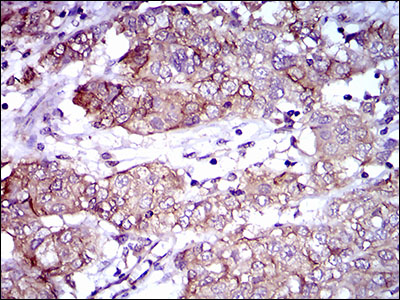 ALCAM / CD166 Antibody - IHC of paraffin-embedded bladder cancer tissues using ALCAM mouse monoclonal antibody with DAB staining.