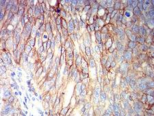 ALCAM / CD166 Antibody - Immunohistochemical analysis of paraffin-embedded ovarian cancer tissues using CD166 mouse mAb with DAB staining.