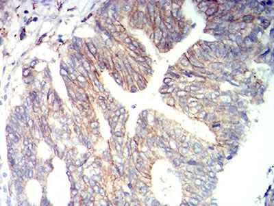 ALCAM / CD166 Antibody - Immunohistochemical analysis of paraffin-embedded rectum cancer tissues using CD166 mouse mAb with DAB staining.