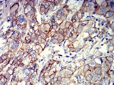 ALCAM / CD166 Antibody - Immunohistochemical analysis of paraffin-embedded bladder cancer tissues using CD166 mouse mAb with DAB staining.