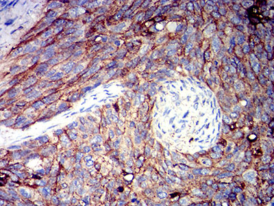 ALCAM / CD166 Antibody - Immunohistochemical analysis of paraffin-embedded cervical cancer tissues using CD166 mouse mAb with DAB staining.