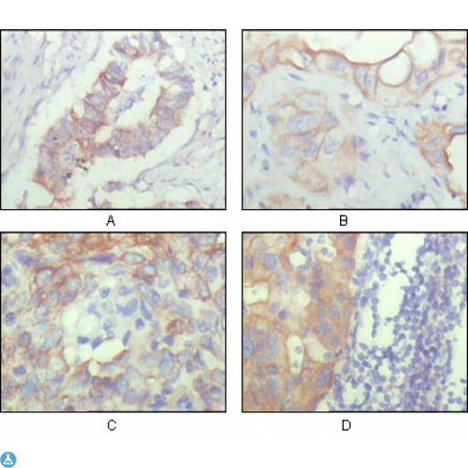 ALCAM / CD166 Antibody - Immunohistochemistry (IHC) analysis of paraffin-embedded Human Ovary carcinoma (A), kidney carcinoma (B), lung carcinoma (C) and breast carcinoma (D), showing cytoplasmic and membrane localization with DAB staining using CD166 Monoclonal Antibody.