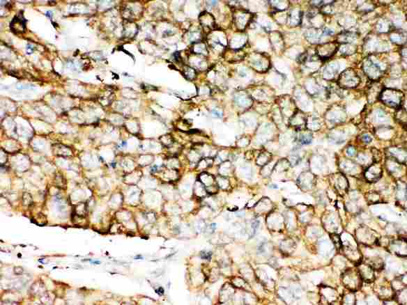 ALDH1A1 / ALDH1 Antibody - Anti-ALDH1A1 antibody, IHC(P): Human Lung Cancer Tissue