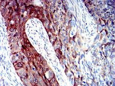ALDH1A1 / ALDH1 Antibody - Immunohistochemical analysis of paraffin-embedded cervical cancer tissues using ALDH1A1 mouse mAb with DAB staining.