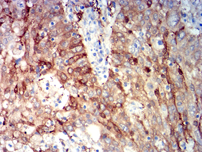 ALDH1A1 / ALDH1 Antibody - Immunohistochemical analysis of paraffin-embedded stomach cancer tissues using ALDH1A1 mouse mAb with DAB staining.