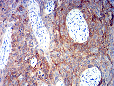 ALDH1A1 / ALDH1 Antibody - Immunohistochemical analysis of paraffin-embedded cervical cancer tissues using ALDH1A1 mouse mAb with DAB staining.