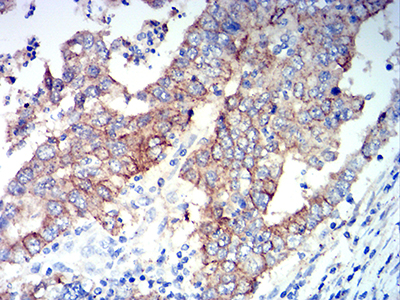 ALDH1A1 / ALDH1 Antibody - Immunohistochemical analysis of paraffin-embedded stomach cancer tissues using ALDH1A1 mouse mAb with DAB staining.