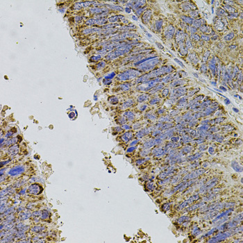 ALDH1A1 / ALDH1 Antibody - Immunohistochemistry of paraffin-embedded human colon carcinoma using ALDH1A1 antibodyat dilution of 1:100 (40x lens).