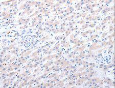 ALDH1A1 + ALDH1A2 + ALDH1A3 Antibody - Immunohistochemistry of paraffin-embedded Human liver cancer using ALDH1A1/ALDH1A2/ALDH1A3 Polyclonal Antibody at dilution of 1:40.