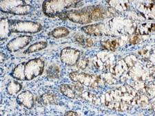 ALDH1A3 Antibody - IHC testing of FFPE human stomach cancer tissue with ALDH1A3 antibody at 1ug/ml. Required HIER: steam section in pH6 citrate buffer for 20 min and allow to cool prior to testing.