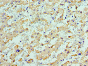 ALDH1L1 Antibody - Immunohistochemistry of paraffin-embedded human liver cancer using antibody at 1:100 dilution.
