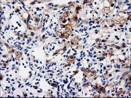 ALDH1L1 Antibody - IHC of paraffin-embedded Carcinoma of Human kidney tissue using anti-ALDH1L1 mouse monoclonal antibody.