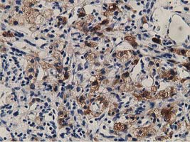 ALDH1L1 Antibody - IHC of paraffin-embedded Carcinoma of Human kidney tissue using anti-ALDH1L1 mouse monoclonal antibody.