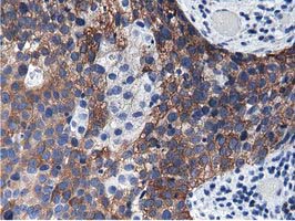ALDH1L1 Antibody - IHC of paraffin-embedded Carcinoma of Human bladder tissue using anti-ALDH1L1 mouse monoclonal antibody.