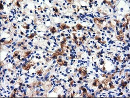 ALDH1L1 Antibody - Immunohistochemical staining of paraffin-embedded Carcinoma of Human kidney tissue using anti-ALDH1L1 mouse monoclonal antibody.