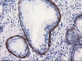 ALDH1L1 Antibody - Immunohistochemical staining of paraffin-embedded Human prostate tissue using anti-ALDH1L1 mouse monoclonal antibody.