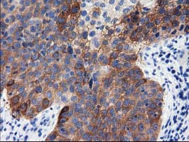 ALDH1L1 Antibody - Immunohistochemical staining of paraffin-embedded Carcinoma of Human bladder tissue using anti-ALDH1L1 mouse monoclonal antibody.