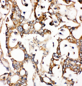 ALDH2 Antibody - ALDH2 antibody. IHC(P): Human Liver Cancer Tissue.